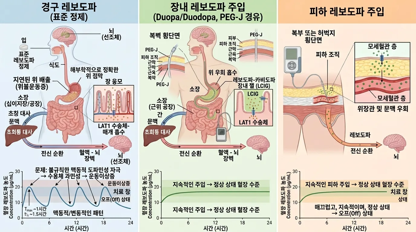 지속적 약물 주입 치료 — 약동학적 원리와 의료기기 해부